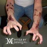 Arms with severe skin wounds and blood stains.