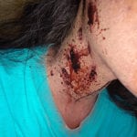 Close-up of a neck injury with visible blood and bruising.