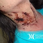 Close-up of a neck injury with dried blood and abrasions.