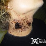 Close-up of a person's neck with dark, patchy skin damage or burn marks.